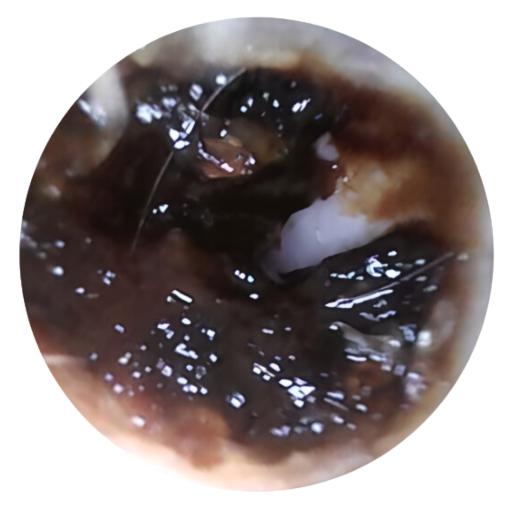 Tapón de cerumen